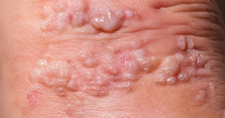 Verrugas genitales y el VPH